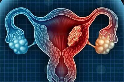 慢性子宫内膜炎怎么治疗？做试管可成功怀孕吗？