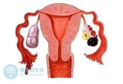 巧克力囊肿是如何让你不孕不育的？该如何治疗？
