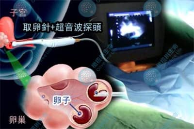 德宏试管婴儿促排取卵前后需要注意哪些事项？