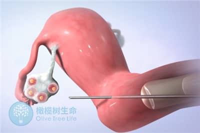 做德宏试管婴儿会导致卵巢过度刺激吗？该如何避免？
