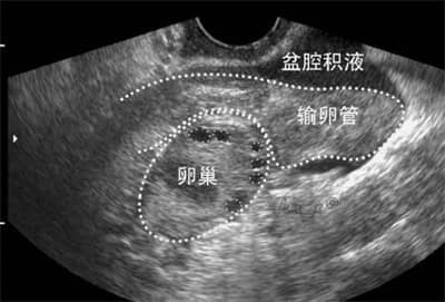 盆腔积液去泰国做七台河试管婴儿要注意什么？