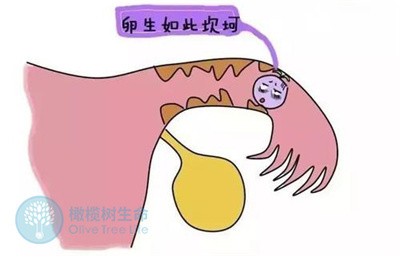 哪些原因会引起宫外孕?做泰安试管婴儿可以避免吗？