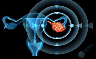如何规避试管助孕周期中的大敌——卵巢过度刺激综合征？
