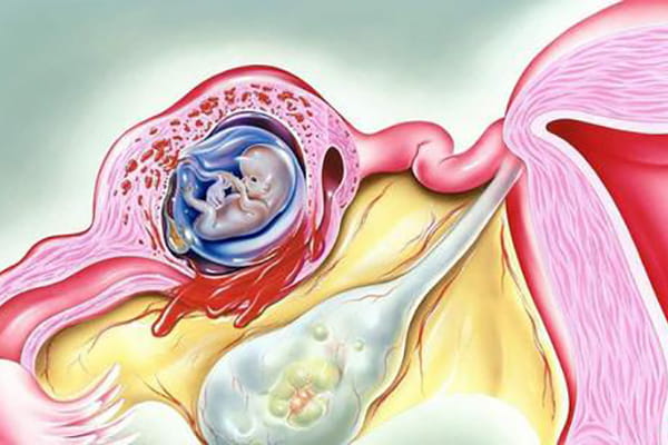 渝北试管婴儿如何避免宫外孕，实现健康优生?