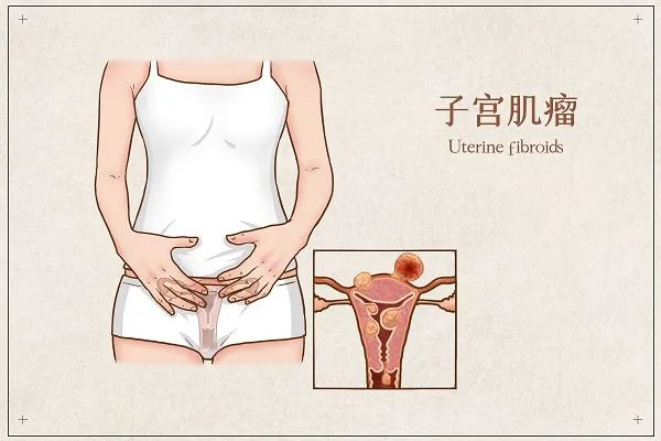 渝北做过子宫肌瘤切除，试管婴儿助孕会影响怀孕吗？